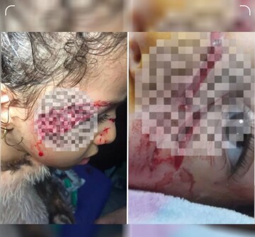 حمله سگ‌های ولگرد در تبریز به دختر ۵ ساله