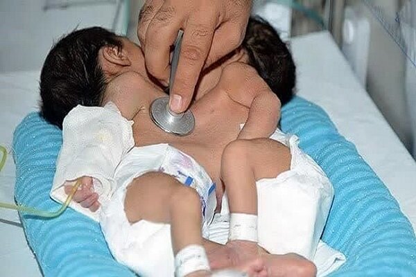 دوقلوهای بههمچسبیده اهوازی در شیراز با موفقیت جدا شدند دوقلوهای بههمچسبیده اهوازی در شیراز با موفقیت جدا شدند