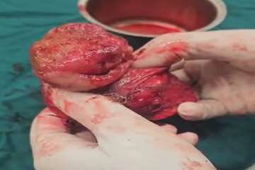 جراحی رفع انسداد روده ناجی جان کودک بندرعباسی شد