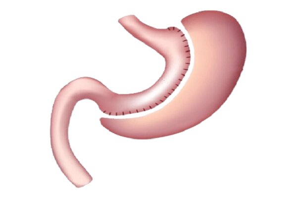 تجربیات افرادی که عمل اسلیو انجام داده اند تجربیات افرادی که عمل اسلیو انجام داده اند
