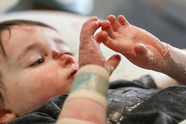 سالانه کودکان ایرانی قربانی تحریمهای ناعادلانه آمریکا میشوند