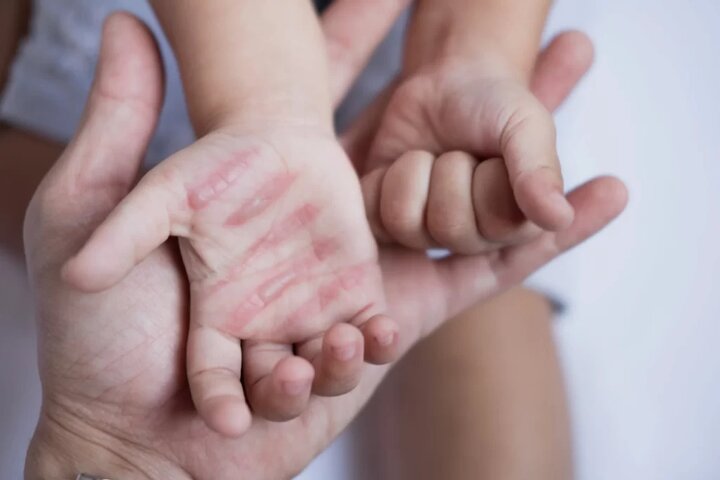 سوختگی؛ آسیب جسمی و روانی که فراتر از درمان است سوختگی؛ آسیب جسمی و روانی که فراتر از درمان است