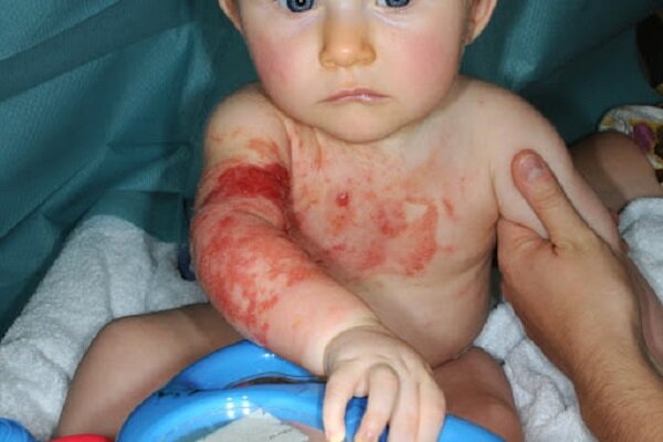 عدم حمایت بیمهها و بخش درمان از بیماران سوانح سوختگی – خبرگزاری مهر | اخبار ایران و جهان