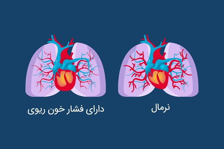 فشار خون را با توصیههای طب ایرانی کنترل کنید