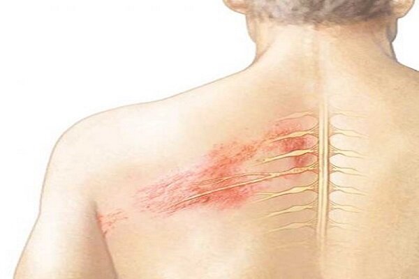 کدام افراد مستعد ابتلا به «زونا» هستند؟