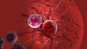 پنجه شاهی: ۱۵ مورد قطعی ابتلا به سرطان پستان در کاشان شناسایی شدند