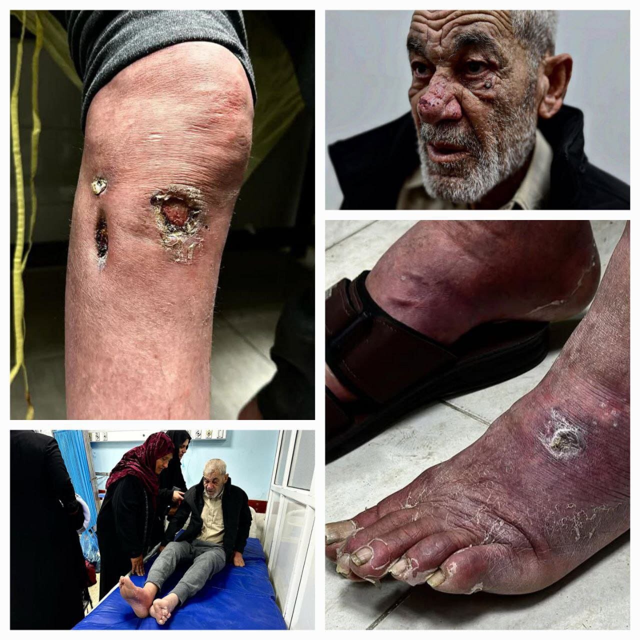 آثار شکنجه شدید روی بدن اسیر فلسطینی پس از آزادی