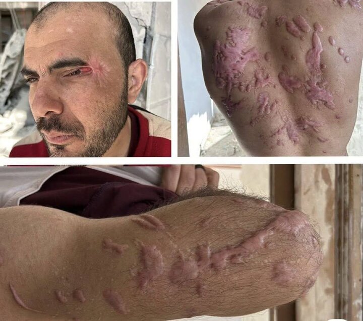 آثار شکنجه وحشیانه صهیونیستها بر بدن اسیر آزادشده فلسطینی+ فیلم