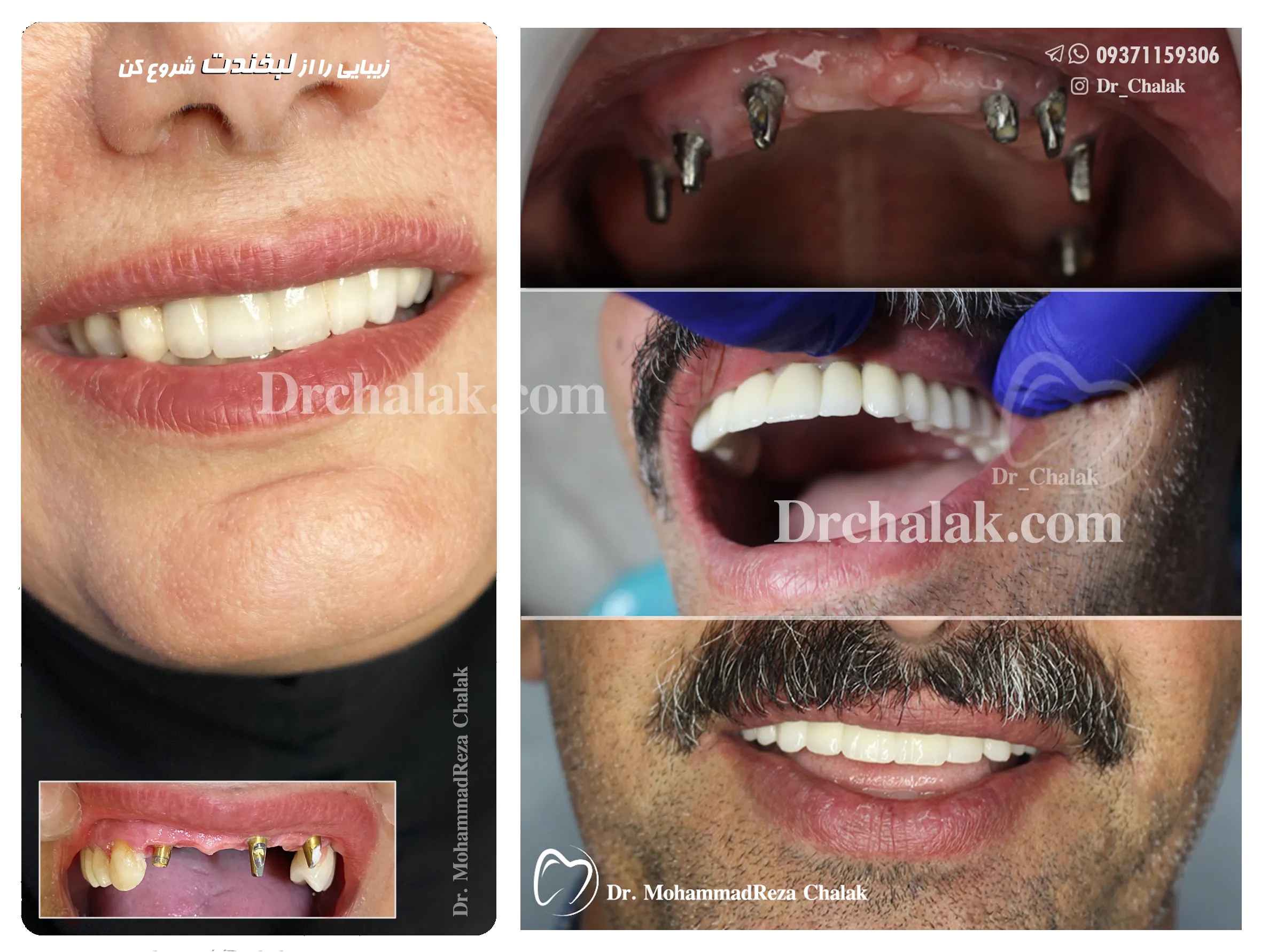 مراقبتهای بعد از ایمپلنت دندان و معرفی دکتر ایمپلنت در مشهد