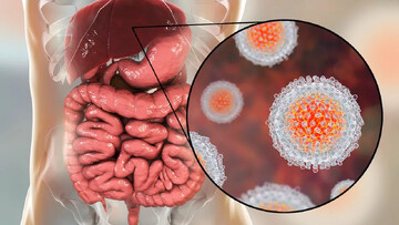 اجرای پویش غربالگری و درمان رایگان هپاتیت C در کردستان
