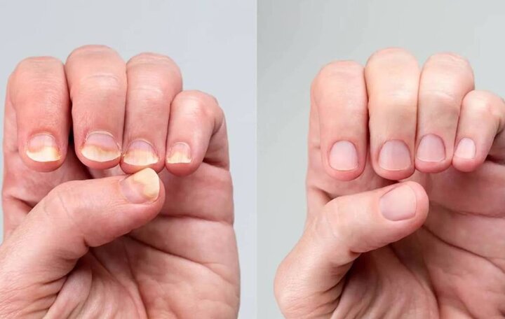 تغییر رنگ ناخنها نشانه چیست؟