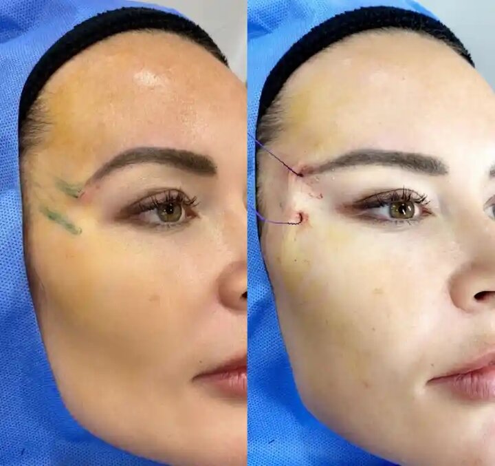 کلاهبرداری به نام «لیفت نخ»! ماجرای ترند زیبایی خطرناک