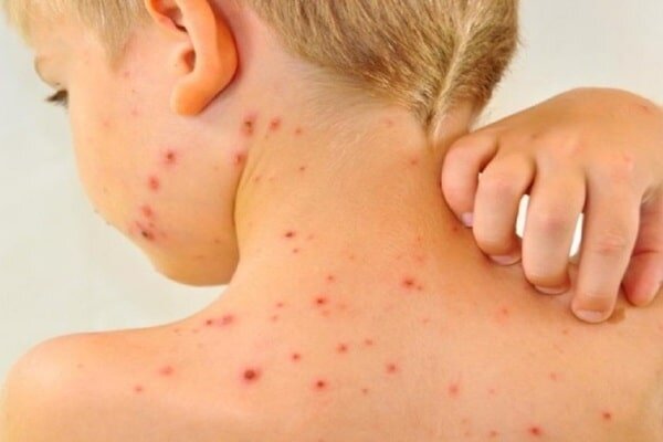 بازگشت سرخک به فارس؛ چرخه واکسیناسیون سرخک باید سریعتر تکمیل شود