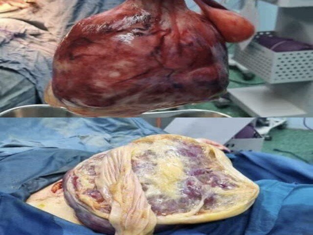 نجات مادر سنندجی از توده ۵ کیلویی نجات مادر سنندجی از توده ۵ کیلویی