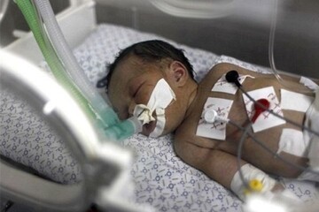 تراژدی نوزادان ناقص‌الخلقه در غزه؛ کودکی که بدون مغز متولد شد