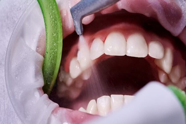 جرمگیری؛ راهکاری مؤثر در جلوگیری از پوسیدگی دندان و بیماریهای لثه – خبرگزاری مهر | تازهترین اخبار ایران و جهان جرمگیری؛ راهکاری مؤثر در جلوگیری از پوسیدگی دندان و بیماریهای لثه – خبرگزاری مهر | تازهترین اخبار ایران و جهان