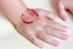 هشدار درباره هاری در دماوند؛ ماهانه ۱۰۰ مورد حیوان‌گزیدگی ثبت می‌شود