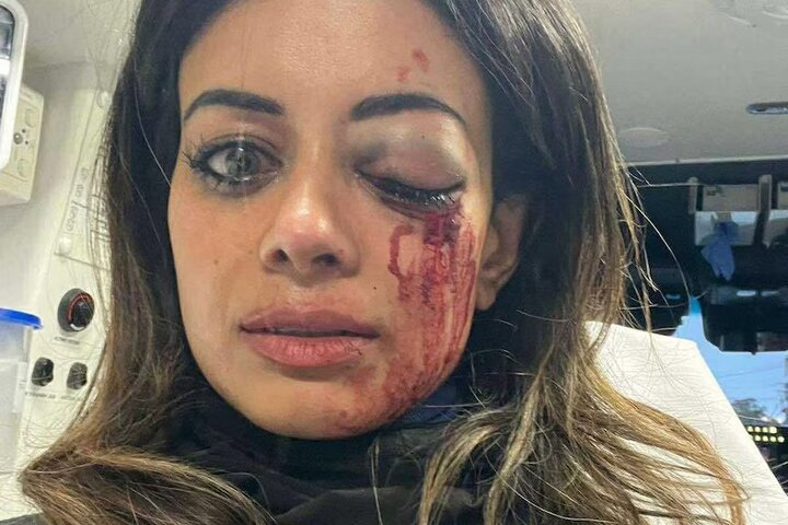 مجروحیت شدید سیاستمدار حامی فلسطین از ناحیه چشم دراعتراضات سیدنی+تصویر