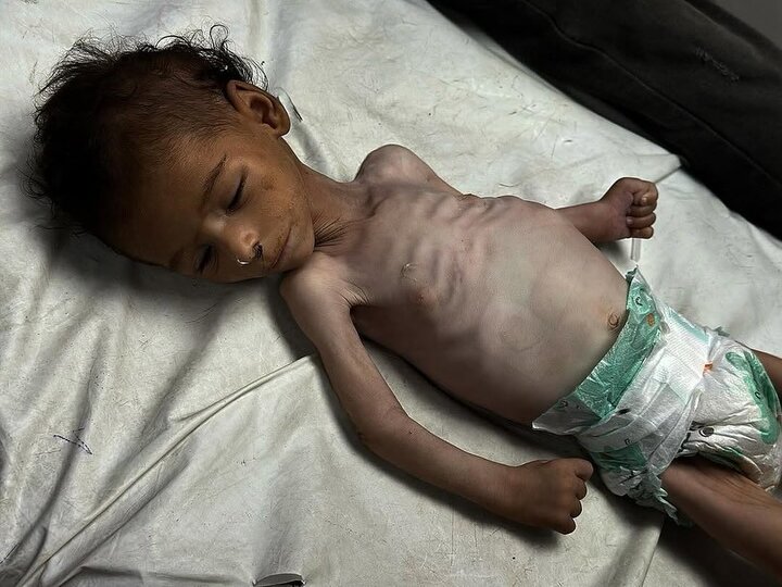 وێنەیەک جیهان شۆک دەکات؛ شەهید بوونی کۆرپەیەکی فەلەستینی بە هۆی برسیەتی
