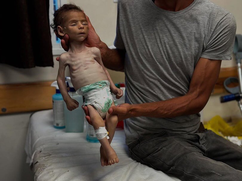 وێنەیەک جیهان شۆک دەکات؛ شەهید بوونی کۆرپەیەکی فەلەستینی بە هۆی برسیەتی