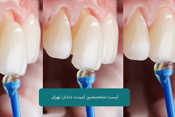 لیست متخصصین لمینت دندان در تهران