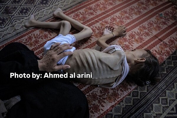 Nine-year-old Palestinian girl unable to walk due to severe malnutrition