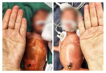 جراحی نجات بخش پارگی روده دوقلوهای نارس در بیمارستان کودکان بندرعباس