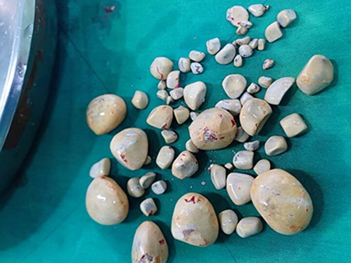 ۶۷ سنگ با ابعاد مختلف از مثانه بیمار در بیمارستان گناوه خارج شد ۶۷ سنگ با ابعاد مختلف از مثانه بیمار در بیمارستان گناوه خارج شد