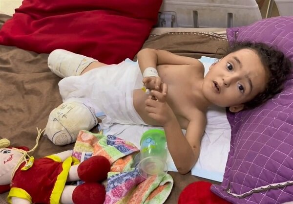 مقام بهداشتی غزه از افزایش ۲۲۵ درصدی قطع عضو در جنگ غزه خبر داد مقام بهداشتی غزه از افزایش ۲۲۵ درصدی قطع عضو در جنگ غزه خبر داد