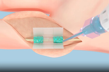 بخیه زدن زخم ها منسوخ می شود