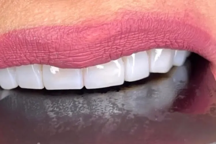 کدام کلینیک انتخاب اول برای لمینت دندان در شرق تهران است؟