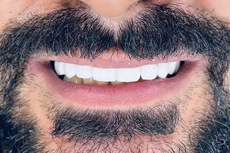 کدام کلینیک انتخاب اول برای لمینت دندان در شرق تهران است؟