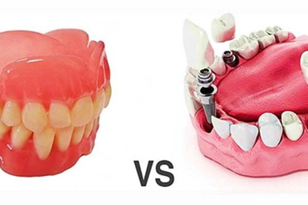 ایمپلنت دندان بهتر است یا دندان مصنوعی؟ بررسی تخصصی و مقایسه هزینهها
