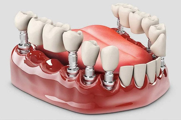ایمپلنت دندان بهتر است یا دندان مصنوعی؟ بررسی تخصصی و مقایسه هزینهها