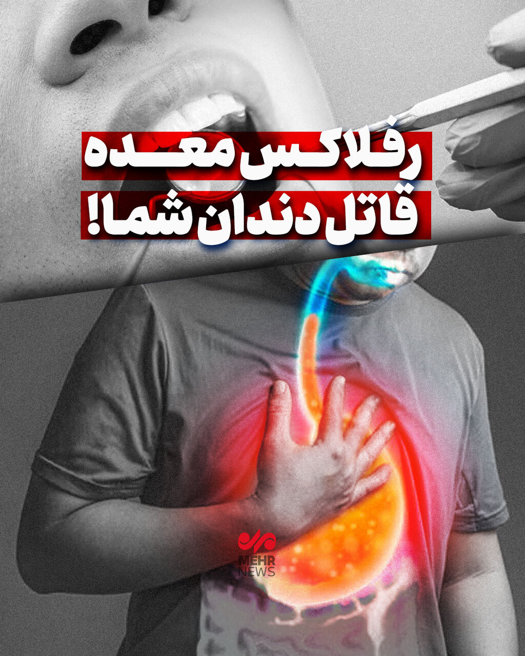رفلاکس معده قاتل دندان شما!
