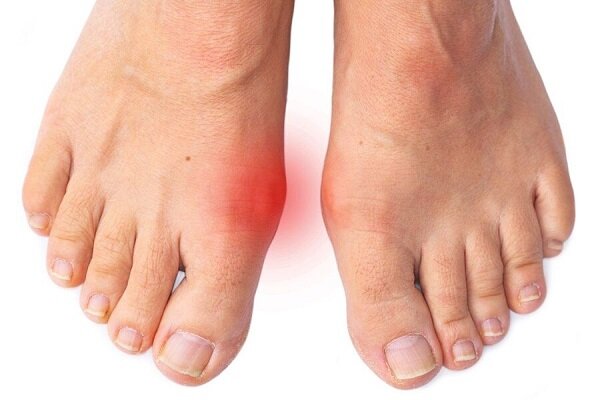 درد شست پا میتواند نشانه بیماریهای جدی باشد درد شست پا میتواند نشانه بیماریهای جدی باشد