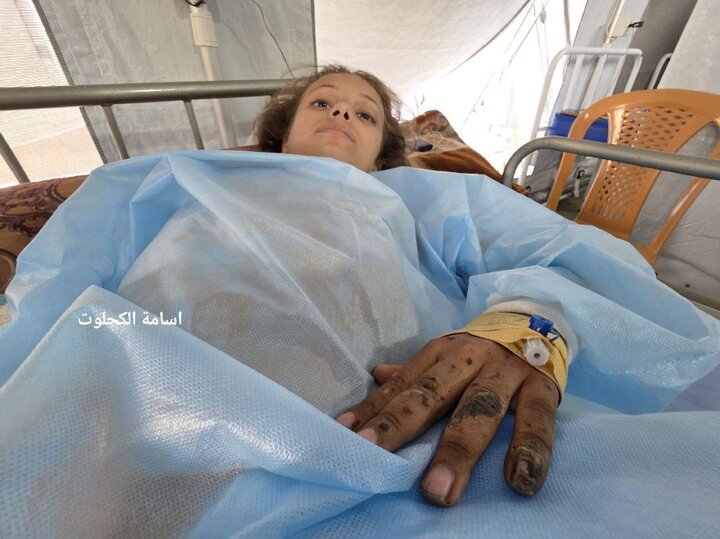 «نور»؛ دختر بچه فلسطینی که پس از بمباران، ۳ عضو بدنش را از دست داد