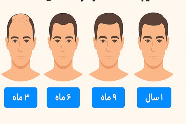 مو،كاشت،نتيجه،ماه،نهايي،موها،تراكم،مرحله،موي،ريزش،كيفيت،طبيع ...