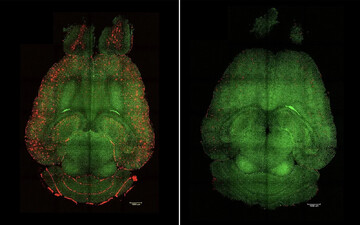 نانوذرات آلزایمر را معکوس کرد