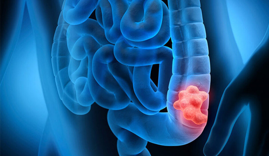 نوشیدن مشروبات الکلی به خطر ابتلا به سرطان روده بزرگ دامن میزند – خبرگزاری مهر | جدیدترین اخبار ایران و جهان نوشیدن مشروبات الکلی به خطر ابتلا به سرطان روده بزرگ دامن میزند – خبرگزاری مهر | جدیدترین اخبار ایران و جهان