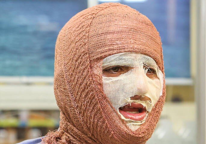 سوختگي،بيماران،درمان،استاندارد،ايجاد،ترميمي،ايمني،پيشگيري،وس ...