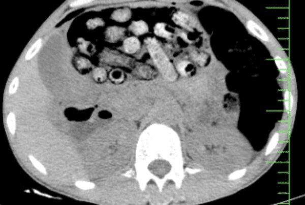 خروج بیش از ۹۰ بسته مواد مخدر از معده و روده یک مرد در کرج