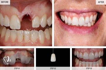 ایمپلنت فوری چیست و چه هزینه، مزایا و معایبی دارد؟