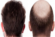 چرا موهای کاشته شده در برخی نواحی رشد نمی‌کنند؟ بررسی دلایل و راه‌حل‌