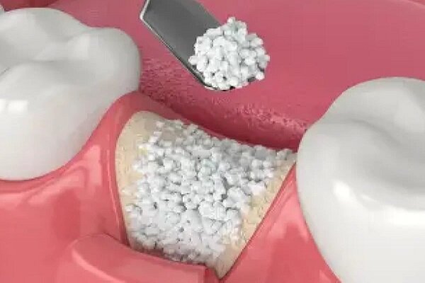 ایمپلنت در اصفهان برای فک‌های ضعیف؛ راهنمای پیوند استخوان و جراحی فک