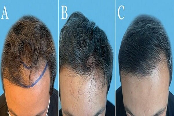 جدیدترین روش‌های کاشت مو در تهران؛