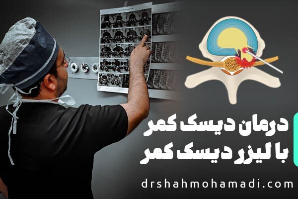 بررسی جامع: چگونگی درمان دیسک کمر با لیزر دیسک کمر PLDD و توصیه‌های جراح متخصص | مهر - کد 0c69