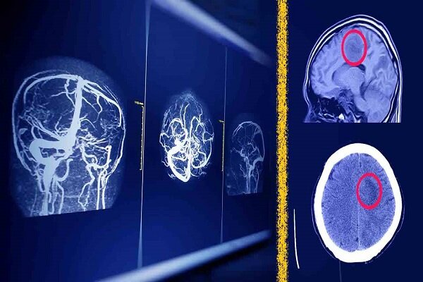 گزارش ویژه: راهکار پژوهشگران دانشگاه تهران برای امنیت هوش مصنوعی در MRI مغز | مهر - کد aaa7