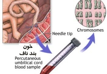 مطابقت نمونه خون بند ناف با نمونه ژنتیکی در ۳۰ ثانیه انجام می شود