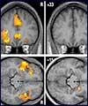 تشخیص افراد روان پریش از افراد سالم با تکنیک های نوین MRI